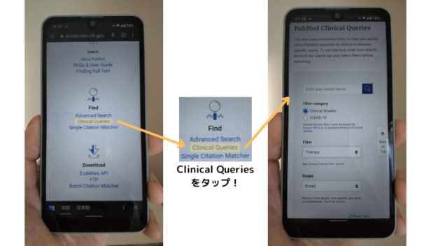 PubMedでClinical queriesを利用する